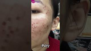 co2 laser before and after treatment comparison acnetreatment [upl. by Yekcim639]