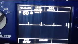 Fulk ECG Analzyer [upl. by Iur]