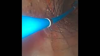 aScope 5 Broncho HD Rigid Bronchoscopy [upl. by Alaj938]