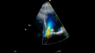 Aortic regurgitation in echocardiography [upl. by Kimmi979]