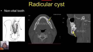 APPROACH TO JAW LESIONS BY DR JYOTI IREP 2020 [upl. by Mehelhteb39]