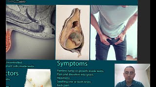 Testicular Cancer Symptoms causes and treatment [upl. by Bostow]