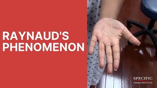 Raynauds Syndrome Phenomenon HELPED by Dr Suh Gonstead Chiropractic NYC [upl. by Abe365]