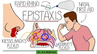 Epistaxis  Nose bleeding NGMedicals [upl. by Lemuelah]