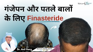 गंजेपन और पतले बालों के लिए Finasteride  FINASTERIDE क्या होता है  Right Dose Of Finasteride [upl. by Dnalyag941]