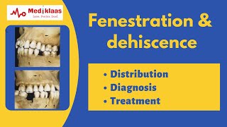 Fenestration and Dehiscence l Periodontal anatomy l Mediklaas [upl. by Yllek816]