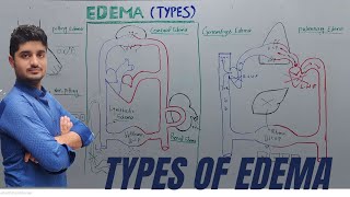 Types of Edema  causespulmonary anasarca cerebral pitting non pitting edema [upl. by Enahc42]