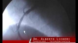 DR ALBERTO LICHERI  STENT COLOCACIÓN SANTA FE  ARGENTINA [upl. by Caty676]