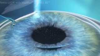 Cirurgia Refrativa a Laser Lasik para Miopia Astigmatismo e Hipermetropia [upl. by Camilo]