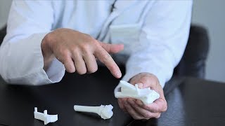 Chirurgie de la main  L’ostéotomie en 3 D  Clinique BoisCerf [upl. by Adnarym]