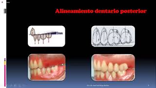 PRÓTESIS TOTAL ENFILADO o ARTICULADO DE DIENTES SUPERIORES [upl. by Idoux]