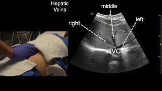 Transverse Liver Scan Technique [upl. by Atteve]