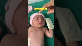 Reflex examination physiology  palmar reflex in newborn  Glabellar reflex in newborn  youtube [upl. by Mukerji352]