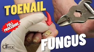 Cutting THICK FUNGALTOENAILS [upl. by Taryne]