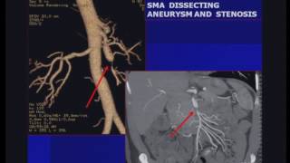 Mesenteric Ischemia US CT and CTA [upl. by Rhoades]