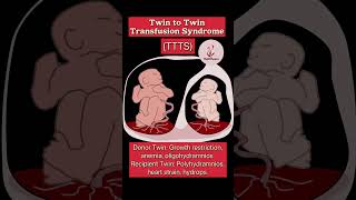 Twin to Twin Transfusion Syndrome biology anatomy cervixdilation obstetrics obstetrician [upl. by Llieno]