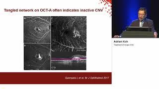 Treatment of myopic CNV Koh Adrian [upl. by Iralam]