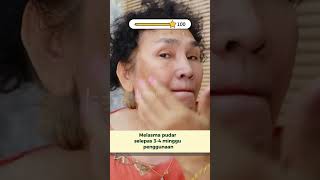 Merawat melasma dan jeragat selepas beberapa minggu menggunakan produk [upl. by Auqinehs]