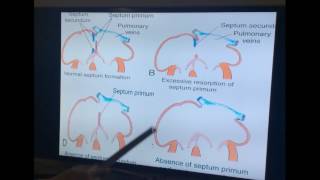 Embryology of Cardiovascular System  Part II by Dr Vijaya  Cardiac Septa amp Ventricles [upl. by Filiano878]