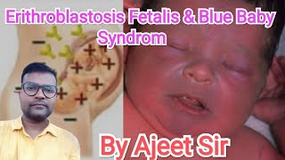 Erithroblastosis Fetalis and Blue baby syndrom By Ajeet Sir [upl. by Aserej]