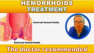 Hemorrhoids treatment [upl. by Atsirtal]