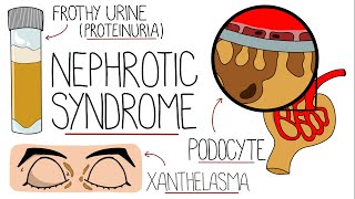 Nephrotic Syndrome Explained Clearly [upl. by Kaitlin]