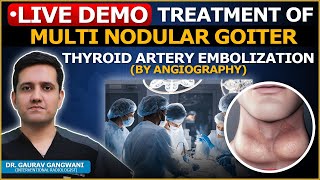 Non Surgical Treatment Of Multi Nodular Goiter  Thyroid Artery Embolization  Dr Gaurav Gangwani [upl. by Birdella]