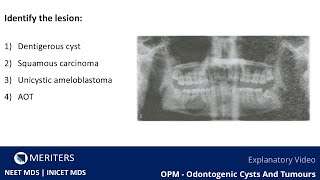 NEET MDS  INICET  OPM  Odontogenic Cysts And Tumours  Explanatory Video  MERITERS [upl. by Llewej]