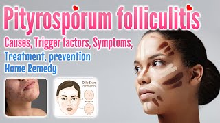 Pityrosporum folliculitis definition causes symptoms diagnosis treatment preventionhome remedy [upl. by Cordell]