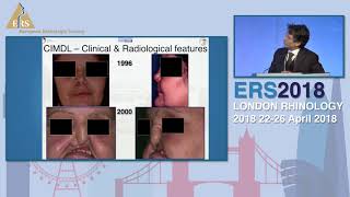 ERS London 2018 Secondary CRS Vasculitides Matteo Trimarchi [upl. by Peppie]