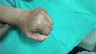 Postburn contracture of left hand [upl. by Cynth]