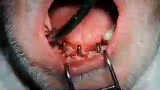 converting partial implant situation into full mandibular arch implants [upl. by Klusek]