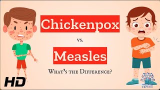 Chickenpox vs Measles Which is Which [upl. by Lieberman833]