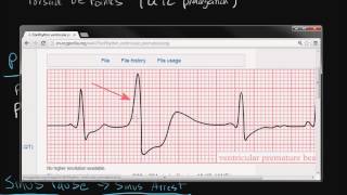 Electrocardiography Cardiac Arrhythmias [upl. by Aldous974]