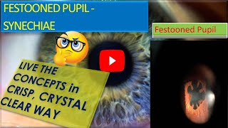 FESTOONED PUPIL WHAT IS FESTOONED PUPIL  WHAT IS SYNECHIAEENGLISH [upl. by Wehtta]