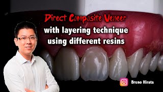 Direct Composite Veneer  The Layering Technique [upl. by Gibbs240]