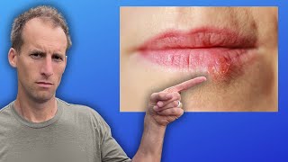 Natural Remedies for Cold Sores [upl. by Chaddie]