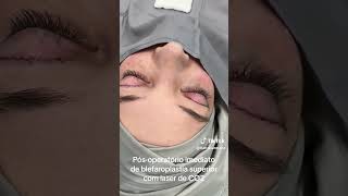 Blefaroplastia com Laser de CO2 [upl. by Eileen]