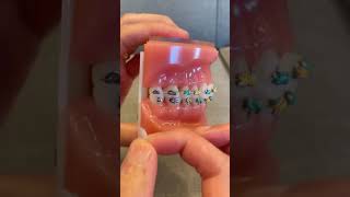 How to Use OrthoDots if Ortho Wax keeps falling off  Dr Bar The Braces Doc [upl. by Dey]