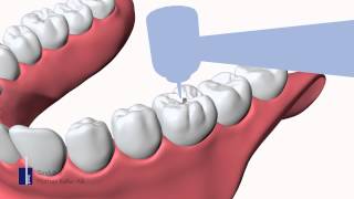 Kariesterapi [upl. by Svensen]