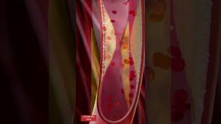 Angioplasty l Coronary artery Stenting l Animation heartattack shorts [upl. by Eirehc]