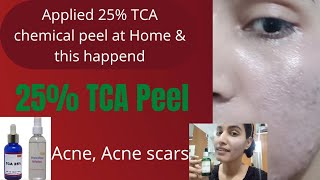 25 TCA chemical Peel At Home  in Hindi मैंने पहली बार अपने चेहरे पर 25 TCA Peel लगाया हैं [upl. by Nhor]