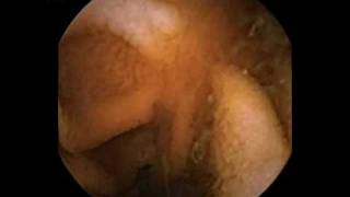 Capsule endoscopy celiacmpg [upl. by Kcirtap507]