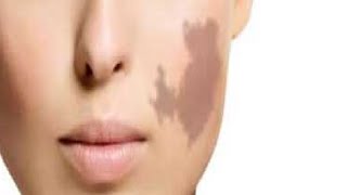 how to get rid of birthmarks on your face at home easy [upl. by Emory752]