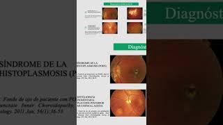 Síndrome de la Histoplasmosis Ocular [upl. by Nannie]