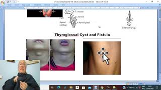 Head and neck surgery in Arabic 3  Thyroglossal cyst   by Dr Wahdan [upl. by Sabah]