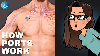 Implanted Port EXPERT Shares Top Tips for Beginners [upl. by Nycila167]