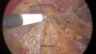 Laparoscopic Etep with Right TAR for recurrent ventral hernia [upl. by Leiram969]