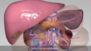 Total pancreatectomy with splenectomy right hemicolectomy and reconstruction of portal vein [upl. by Miru]