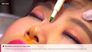 IFAAS Exclusive Training Video Ultra V Hiko Nose Thread Lifting by Dr HanJin Kwon [upl. by Jock]